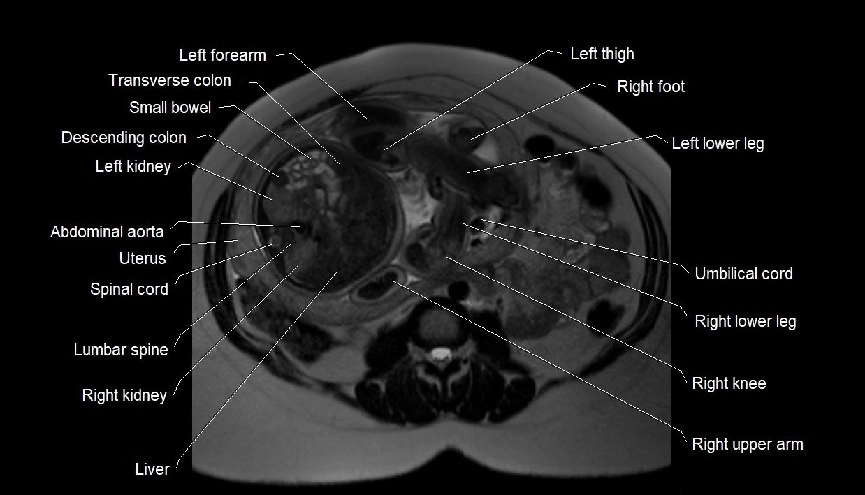 MRI fetal anatomy axial image 11.webp
